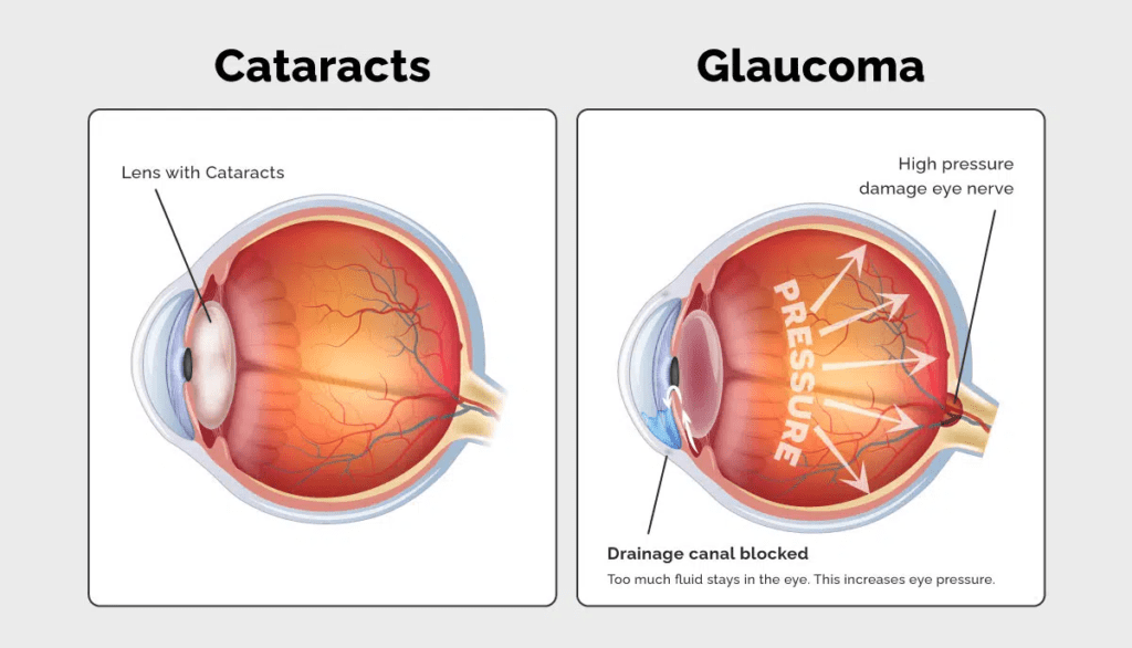 Difference between glaucoma and cataract