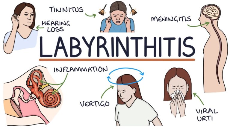 Labyrinthitis symptoms