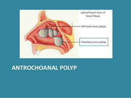 "Antrochoanal Polyp Treatment Without Surgery: 7 Natural Ways to Find Relief!"
