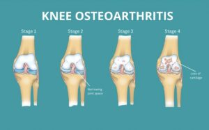 Knee Osteoarthritis