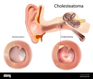 Image of a normal ear drum and an ear drum with cholesteatoma