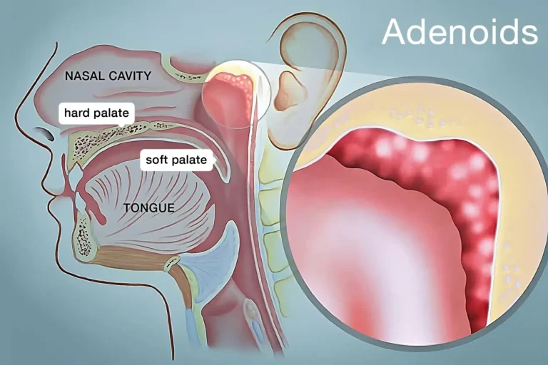 Do Antihistamines Help Adenoids? Expert Answer for Parents