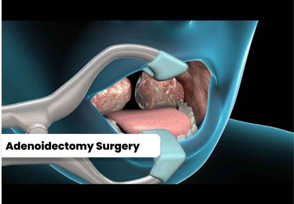 Image of Is Adenoid Surgery Safe?