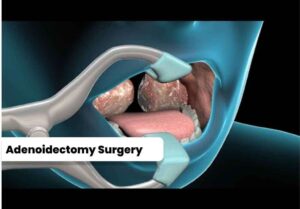 image of Is Adenoid Surgery Safe?