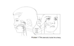 Image of Adenoidectomy