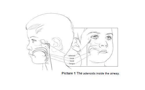 Image of Adenoidectomy