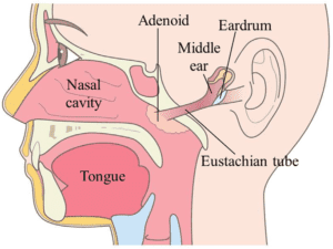 Image of Is there a connection between hearing loss and adenoids?