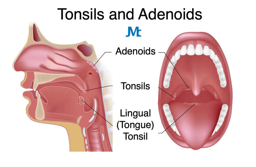 When Are the Worst Days After Tonsillectomy and Adenoidectomy?