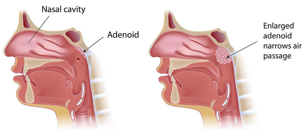 image of How do you know if your adenoidectomy is infected?