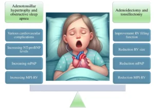 Postoperative Behavioral Changes in Children After Adenoidectomy