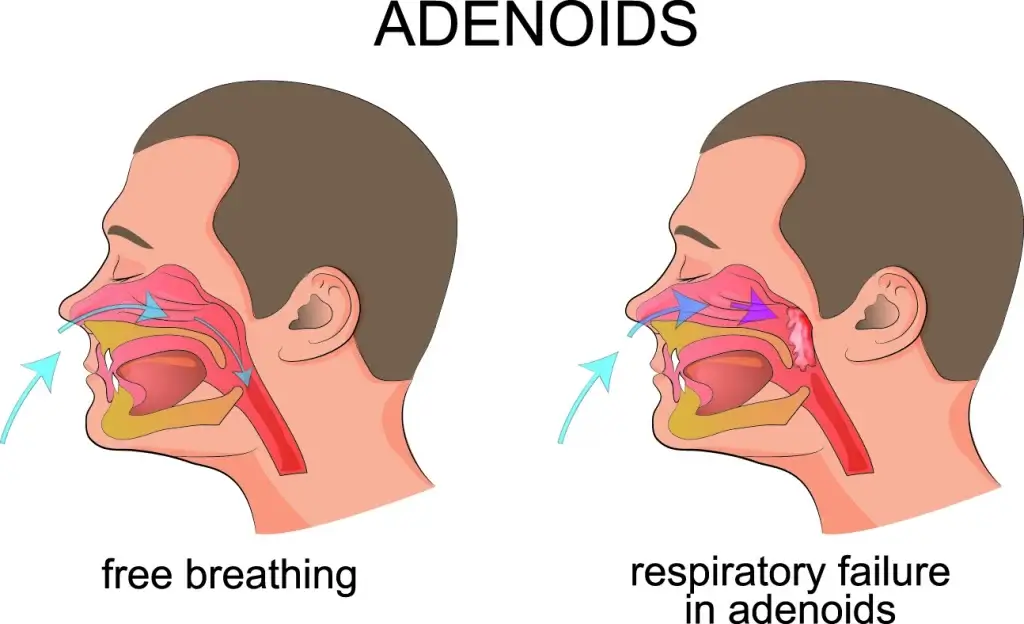What Happens If Adenoids Are Not Removed