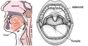 Image of Is Removing Adenoids a Good Idea?