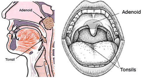 Image of Is Removing Adenoids a Good Idea?