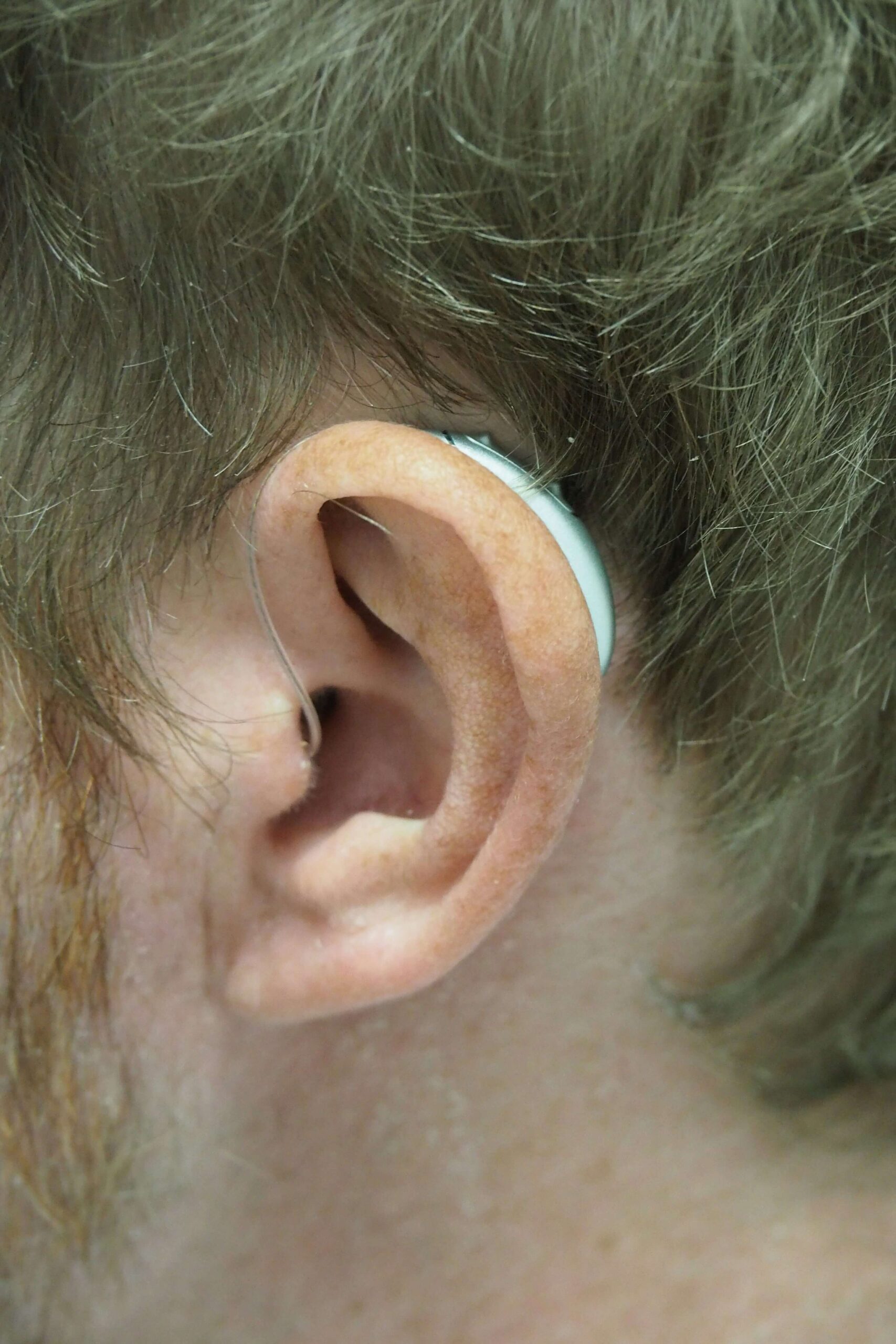Image of Can Enlarged Adenoids Cause Hearing Loss?