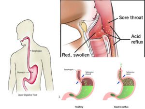 Image of Silent Reflux: The Hidden Cause of Chronic Throat Irritation