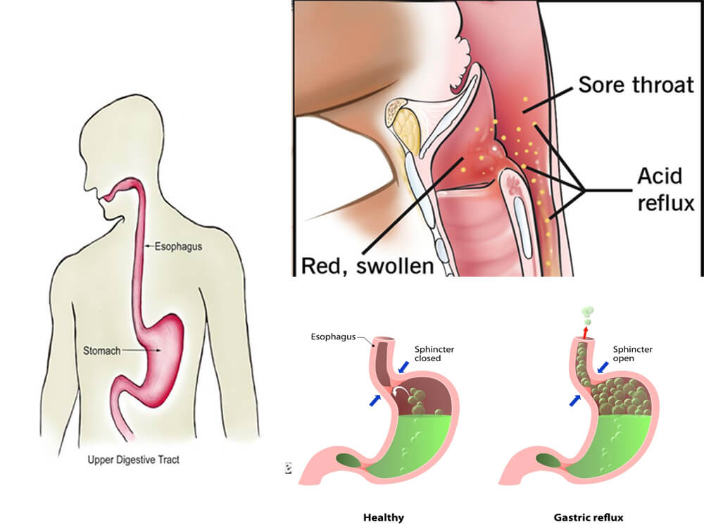 Image of Silent Reflux: The Hidden Cause of Chronic Throat Irritation