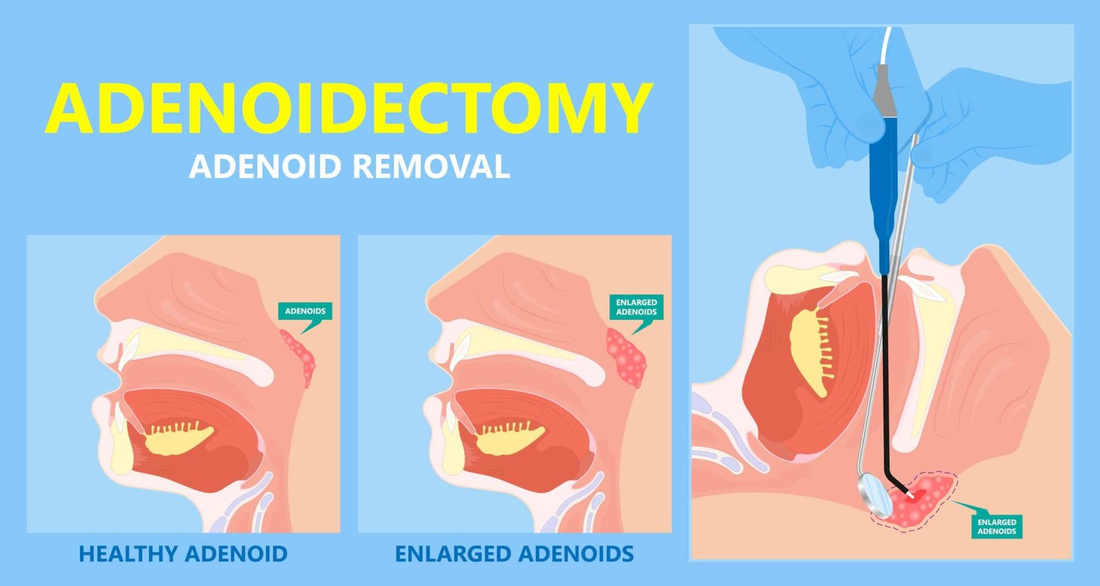 Is removing adenoids a good idea?