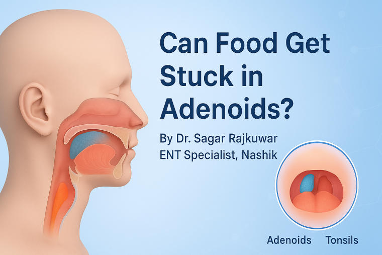 Can food get stuck in adenoids
