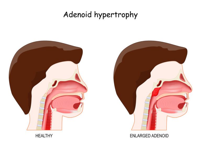 What Organ Are the Adenoids In? Surprising Facts You Should Know!