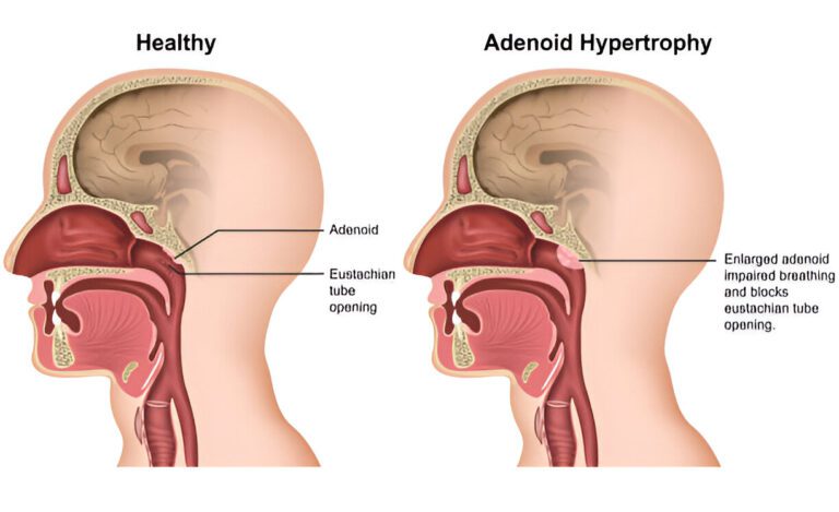How Complicated Is Adenoid Surgery? The Truth Every Parent Should Know