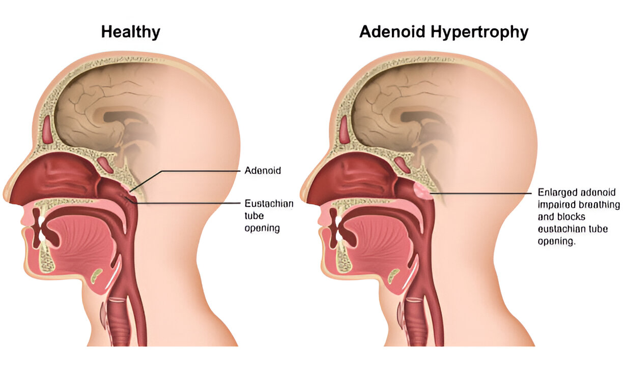 How Complicated Is Adenoid Surgery