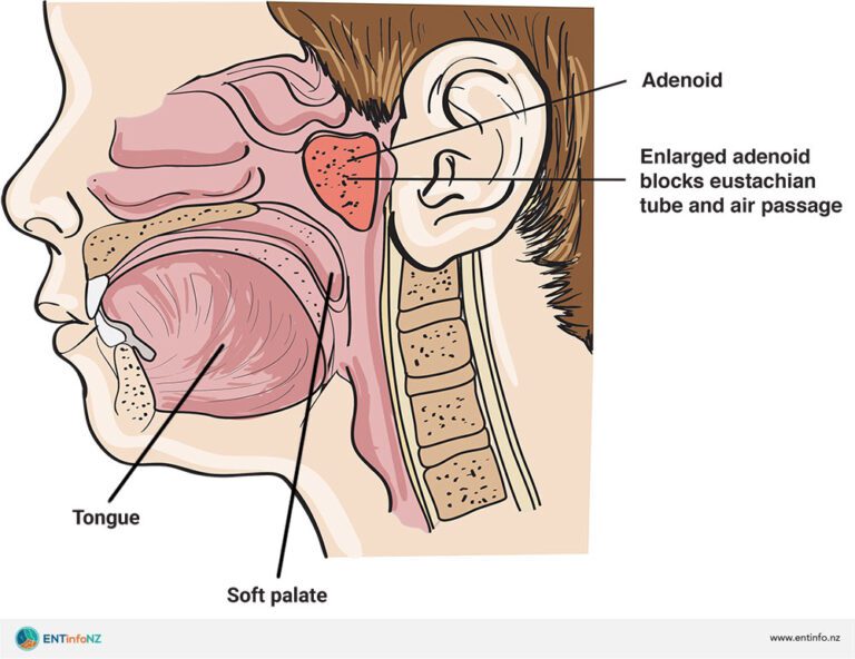 At What Age Are Adenoids Most Active? Every Parent Should Know This!