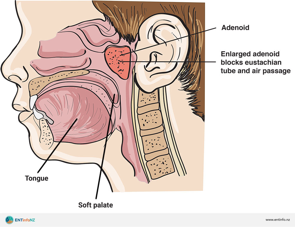 At What Age Are Adenoids Most Active