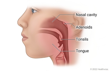 Are Adenoid Problems Genetic?