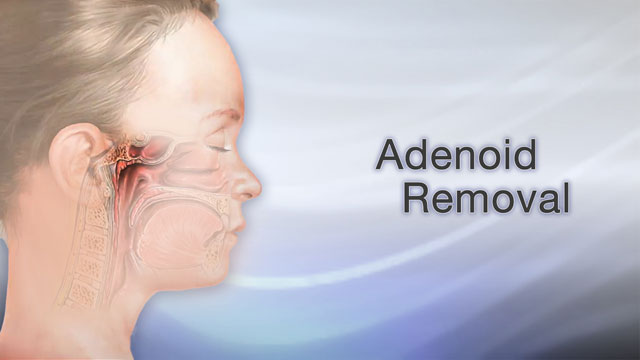 How To Prepare For Adenoid Surgery