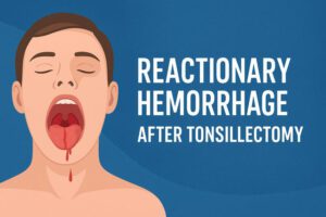 Reactionary Hemorrhage After Tonsillectomy