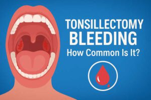 How Common Is Bleeding After Tonsillectomy?