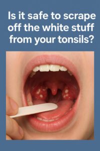 Is It Safe to Scrape the White Stuff Off Your Tonsils?