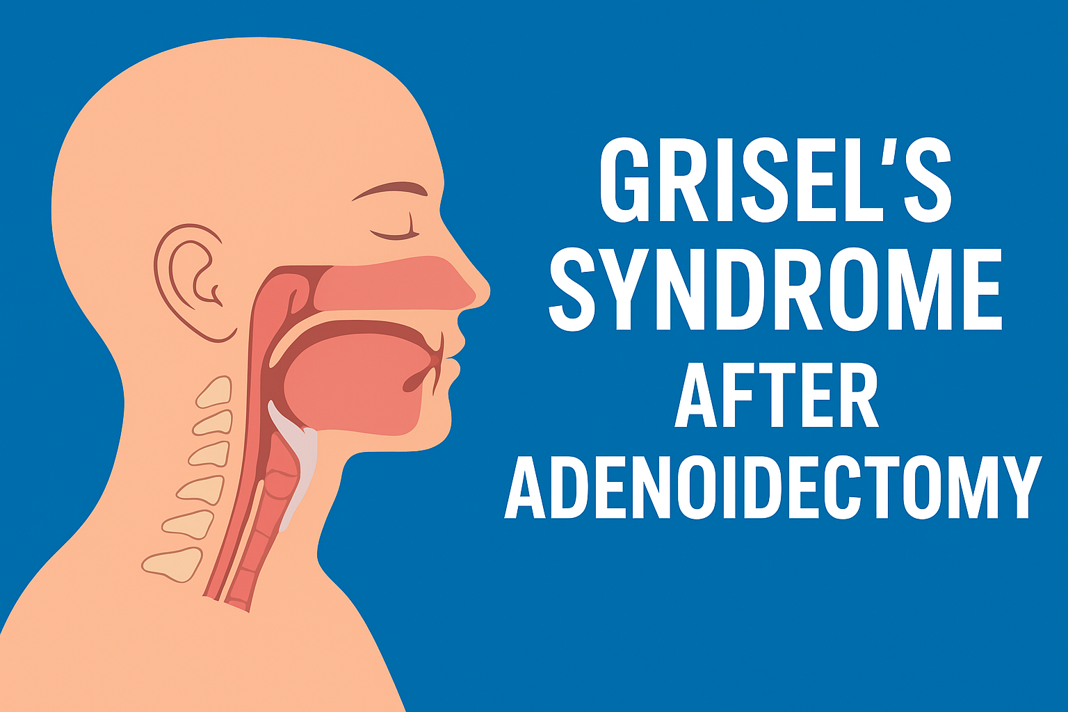 Grisel’s Syndrome After Adenoidectomy