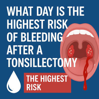 What Day Is the Highest Risk of Bleeding After a Tonsillectomy?