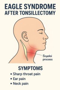 What is Eagle syndrome after tonsillectomy?