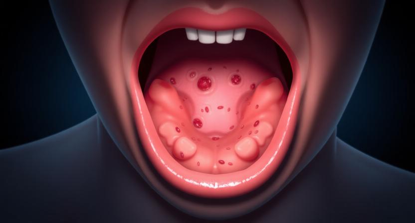 Tonsillectomy Scabs Stuck In Throat