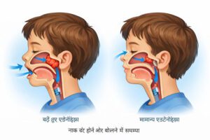 Can adenoids affect speech? in Hindi