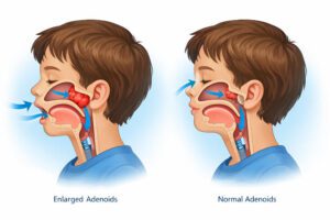 Can adenoids affect speech? in Marathi