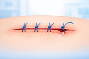 What Do Popped Stitches Feel Like?