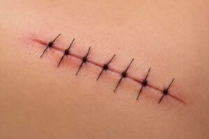 What Happens If Stitches Are Left in Too Long? Risks & Removal