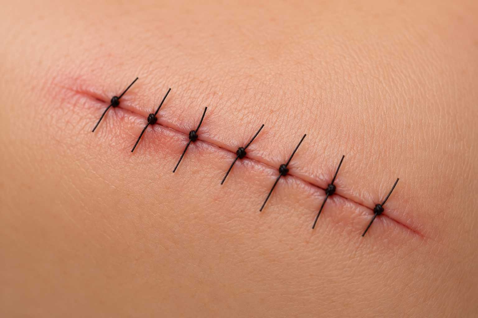 What Happens If Stitches Are Left in Too Long? Risks & Removal