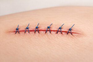 Why Does It Feel Like My Stitches Are Pulling?