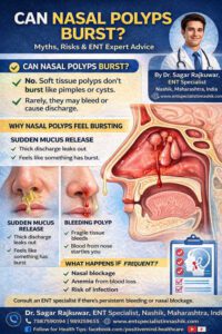 Can Nasal Polyps Burst?