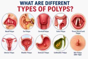 What Are Different Types of Polyps?