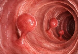 Why are polyps so common?