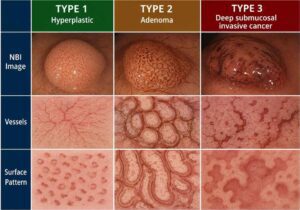 what is a type 2 polyp
