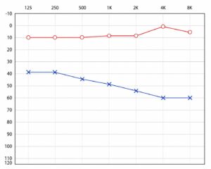 Conductive Hearing Loss Audiogram