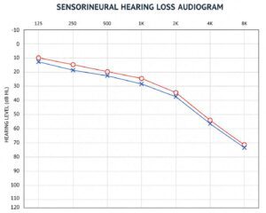 sensorineural hearing loss audiogram