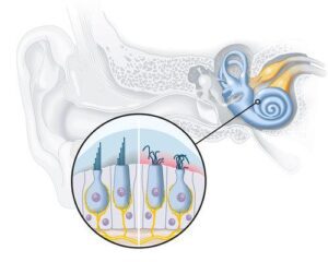What causes sensorineural hearing loss?